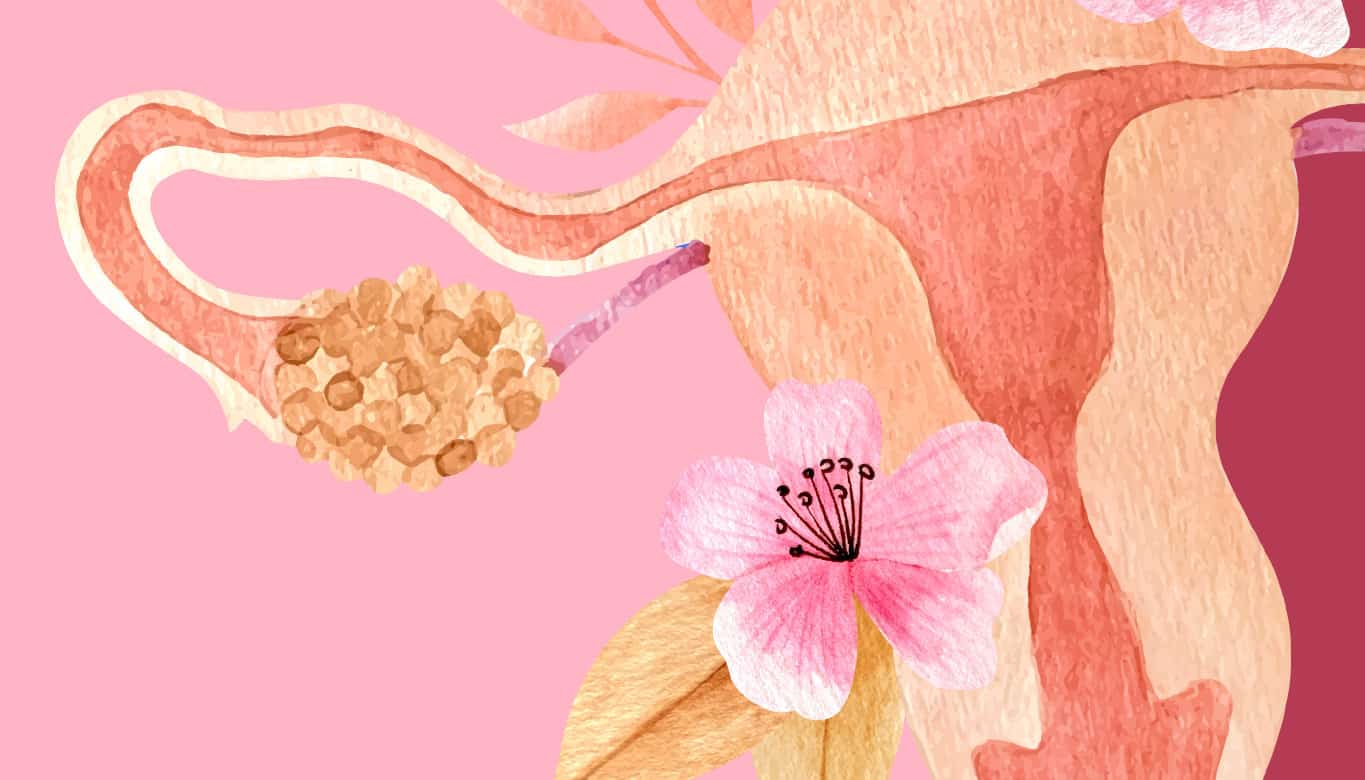 Cistos Ovarianos e Fertilidade